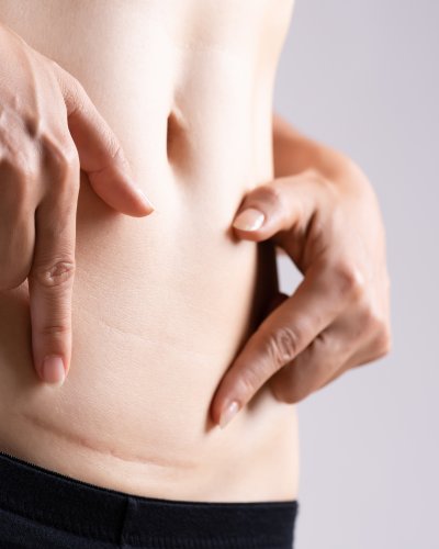 Epizyotomi (Doğum Kesisi) ve Sezaryen Doğum